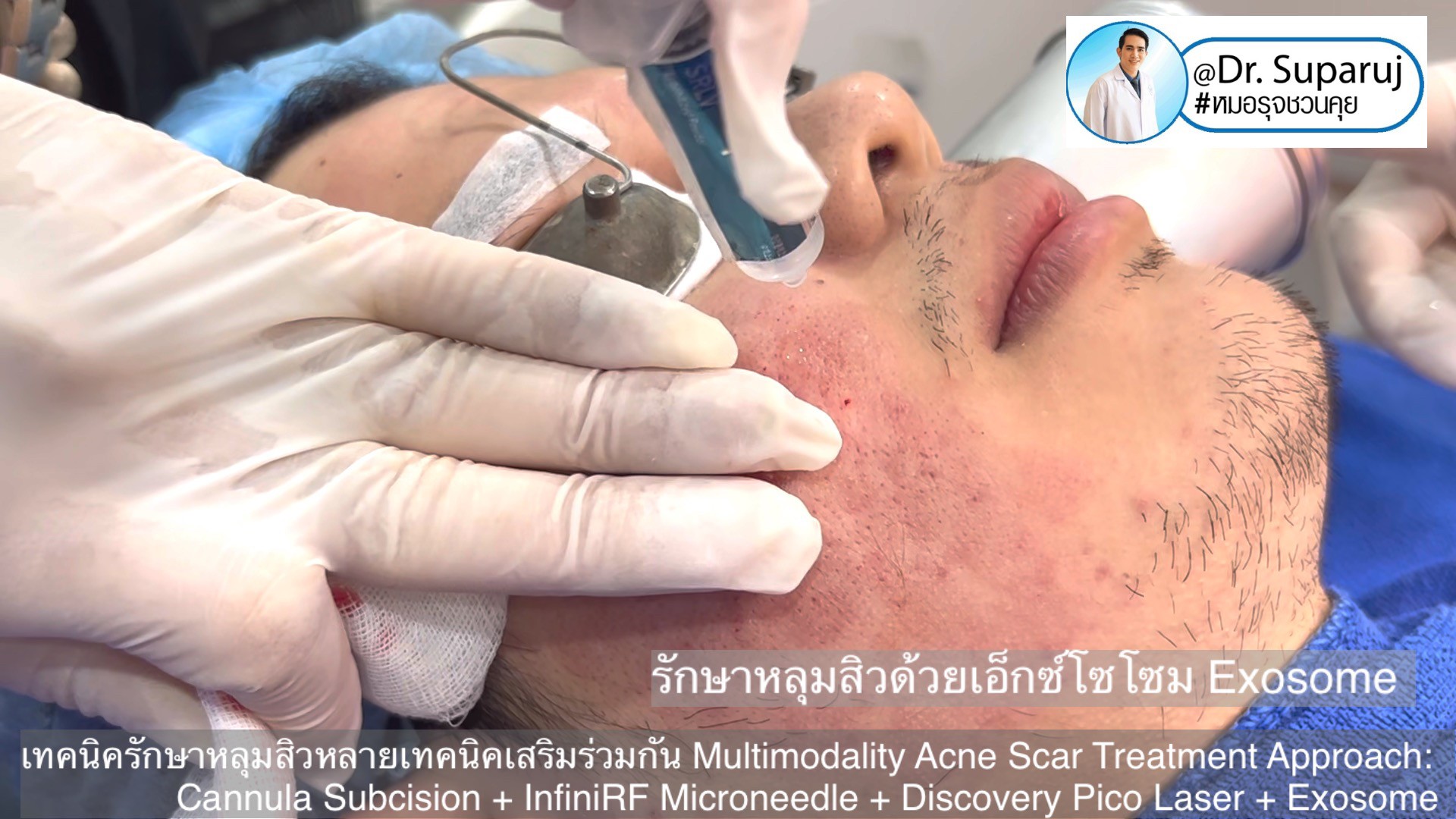 เทคนิครักษาหลุมสิวด้วยหลายเทคนิคเสริมร่วมกัน Multimodality Acne Scar Treatment Approach: Cannula Subcision + InfiniRF Microneedle + Discovery Pico Laser + Exosome