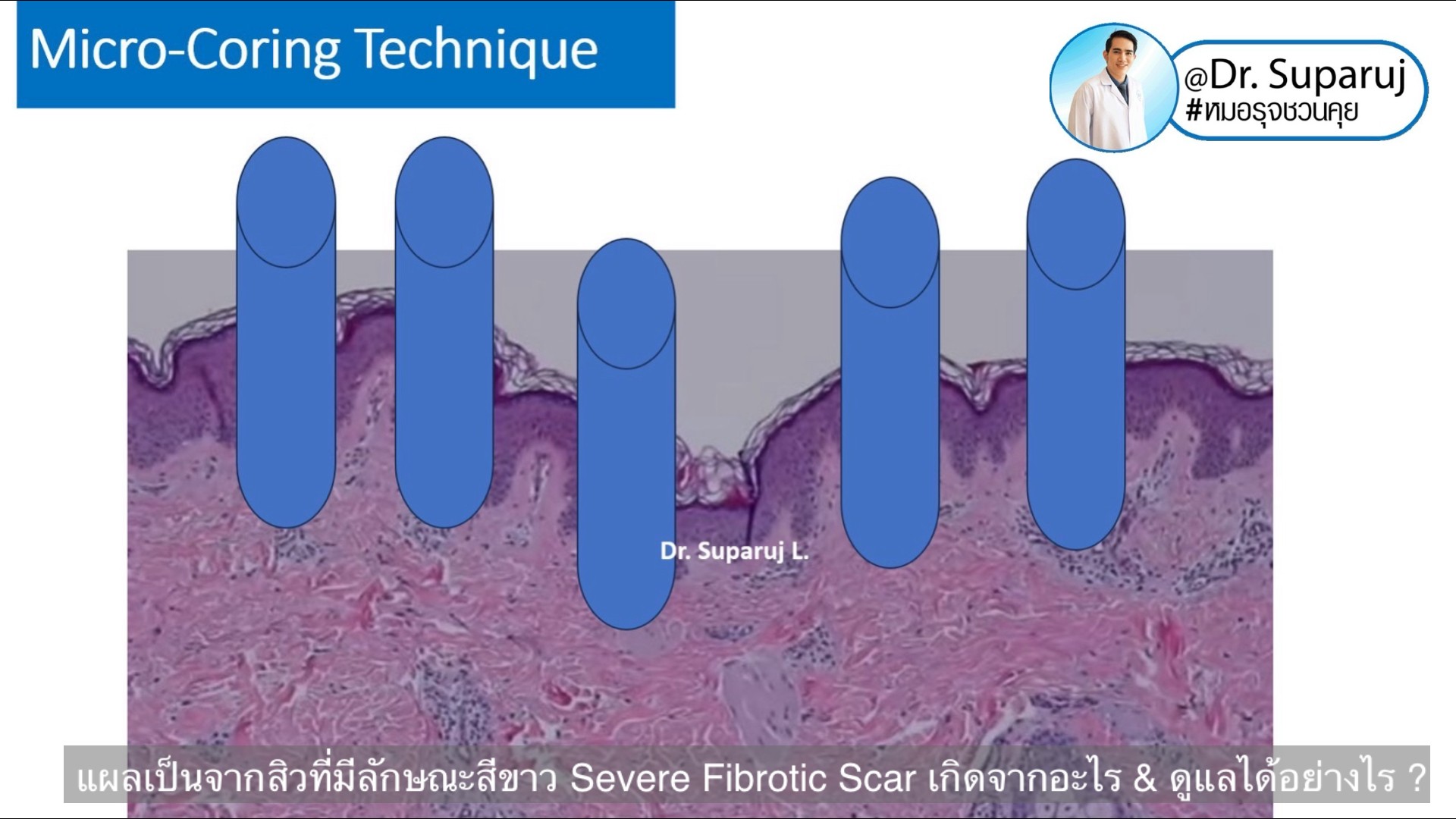 แผลเป็นจากสิวที่มีลักษณะสีขาว severe fibrotic acne scar เกิดจากอะไร & ดูแลได้อย่างไร ?