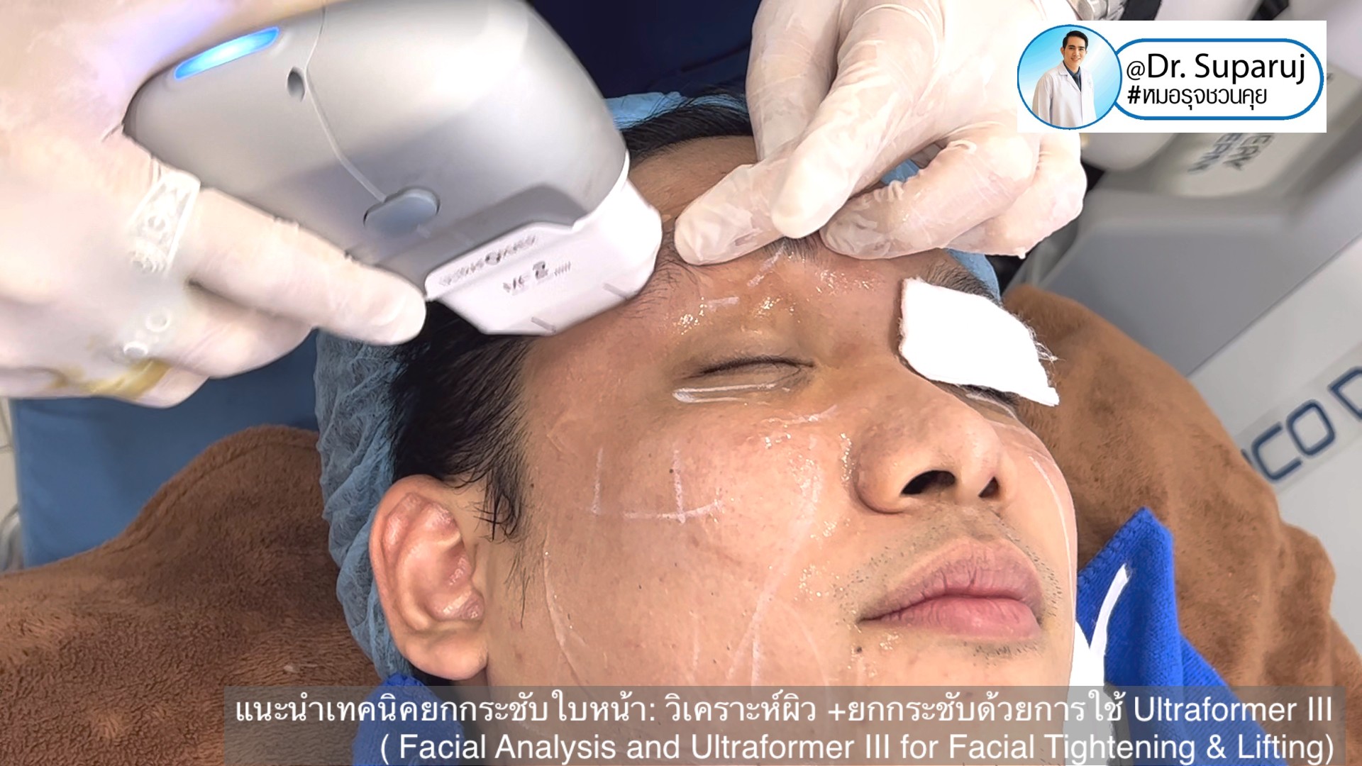 แนะนำเทคนิคยกกระชับใบหน้า: วิเคราะห์ผิว +ยกกระชับด้วย Ultraformer III ( Facial Analysis and Ultraformer III for Facial Tightening & Lifting) แนะนำเทคนิคยกกระชับใบหน้า: วิเคราะห์ผิว +ยกกระชับด้วย Ultraformer III ( Facial Analysis and Ultraformer III for Facial Tightening & Lifting)