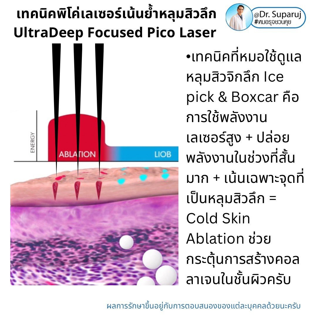 Update เทคนิครักษาหลุมสิว: หลุมสิวแบบจิกลึก Ice Pick Acne Scar มีลักษณะ & ดูแลได้อย่างไร ?