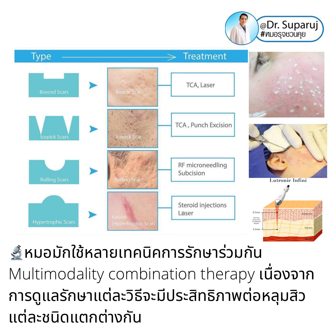 เป็นหลุมสิว แต่ยังไม่พร้อมรักษาหลุมสิว ทำอย่างไรดี? (+ เทคนิคการ เลือกใช้วิธีรักษาลุมสิวเบื้องต้นครับ)