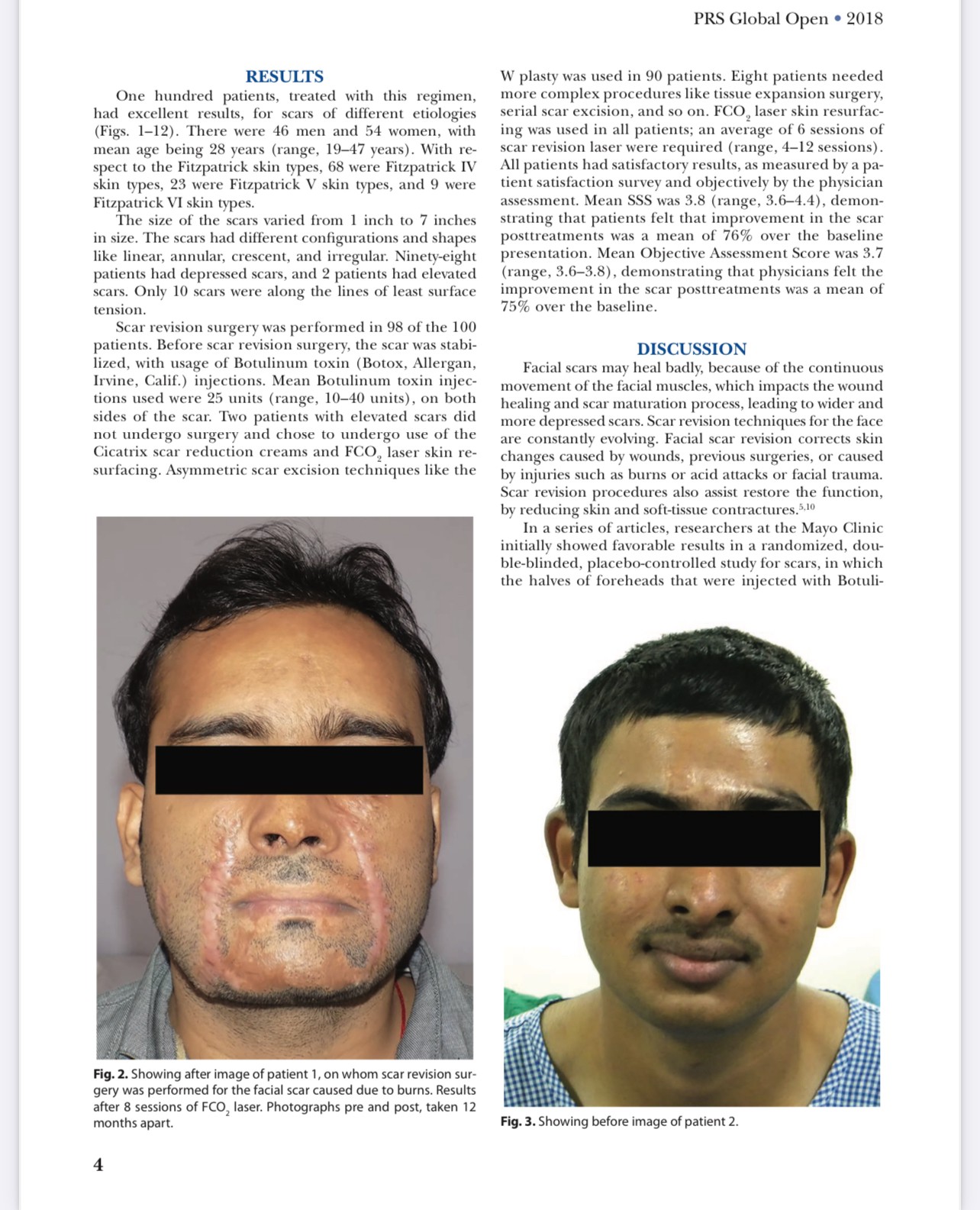 Update เทคนิครักษาแผลเป็นนูนคีลอยด์แผลผ่าตัดด้วยการใช้หลายเลเซอร์ร่วมกัน + เทคนิคการใช้การฉีดโบทูลินัมท็อกซิน (Botox) รักษาแผลเป็นนูนคีลอยด์ Update เทคนิครักษาแผลเป็นนูนคีลอยด์แผลผ่าตัดด้วยการใช้หลายเลเซอร์ร่วมกัน + เทคนิคการใช้การฉีดโบทูลินัมท็อกซิน (Botox) รักษาแผลเป็นนูนคีลอยด์