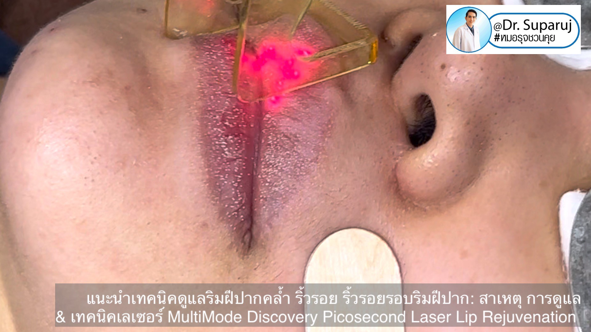 แนะนำเทคนิคดูแลริมฝีปากคล้ำ Lip Hyperpigmentation ริ้วรอย ริ้วรอยรอบริมฝีปาก: สาเหตุ การดูแล & เทคนิคเลเซอร์ MultiMode Discovery Picosecond Laser Lip Rejuvenation แนะนำเทคนิคดูแลริมฝีปากคล้ำ Lip Hyperpigmentation ริ้วรอย ริ้วรอยรอบริมฝีปาก: สาเหตุ การดูแล & เทคนิคเลเซอร์ MultiMode Discovery Picosecond Laser Lip Rejuvenation