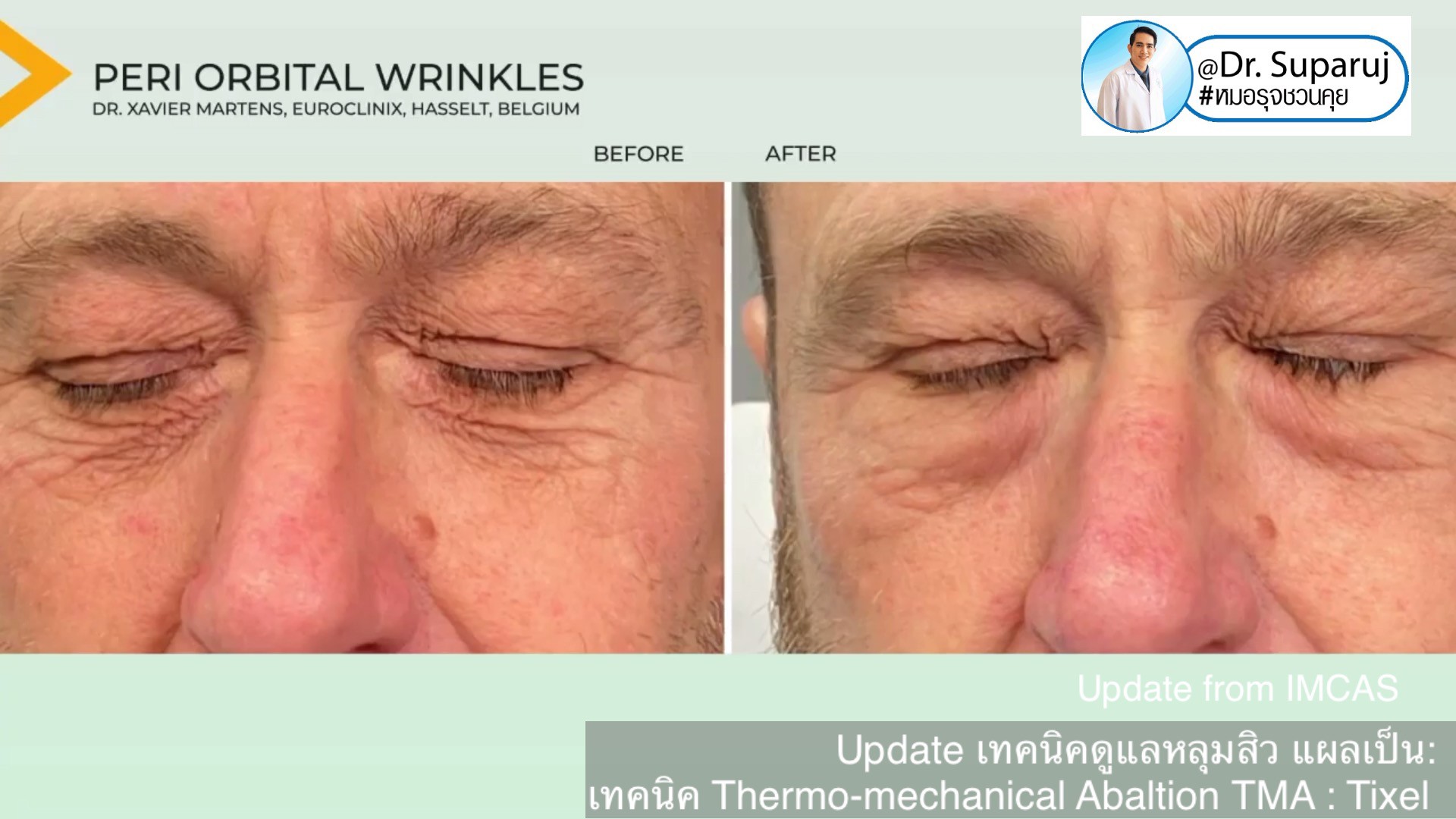 Update from IMCAS เทคนิครักษาหลุมสิว แผลเป็น ริ้วรอย: Tixel เทคนิค Thermo-mechanical Abaltion TMA Update from IMCAS เทคนิครักษาหลุมสิว แผลเป็น ริ้วรอย: Tixel เทคนิค Thermo-mechanical Abaltion TMA