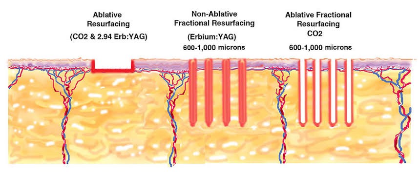 โปรแกรมเลเซอร์ Fractional CO2 Laser ยังใช้รักษาหลุมสิวได้อยู่ไหม ? โปรแกรมเลเซอร์ Fractional CO2 Laser ยังใช้รักษาหลุมสิวได้อยู่ไหม ?