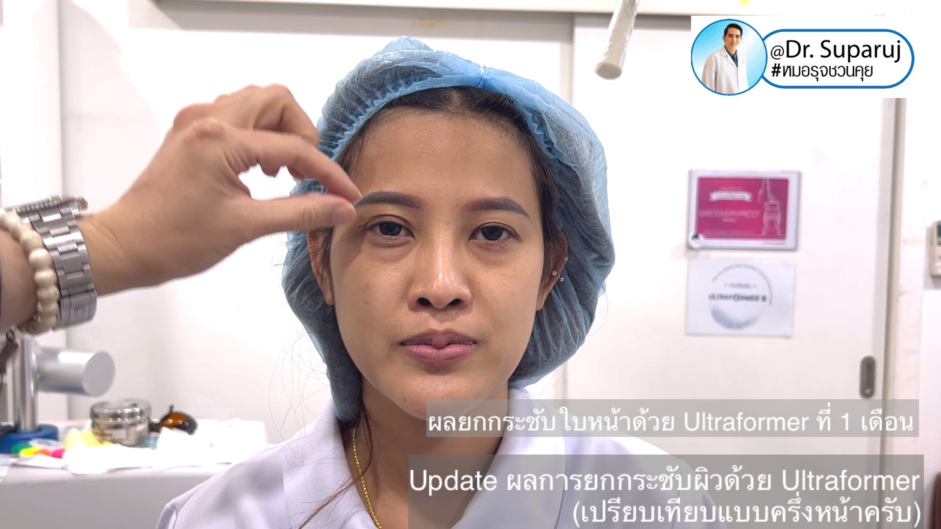 Update ผลการยกกระชับผิวด้วย Ultraformer III (เปรียบเทียบแบบครึ่งหน้าให้เห็นชัดๆครับ) Update ผลการยกกระชับผิวด้วย Ultraformer III (เปรียบเทียบแบบครึ่งหน้าให้เห็นชัดๆครับ)