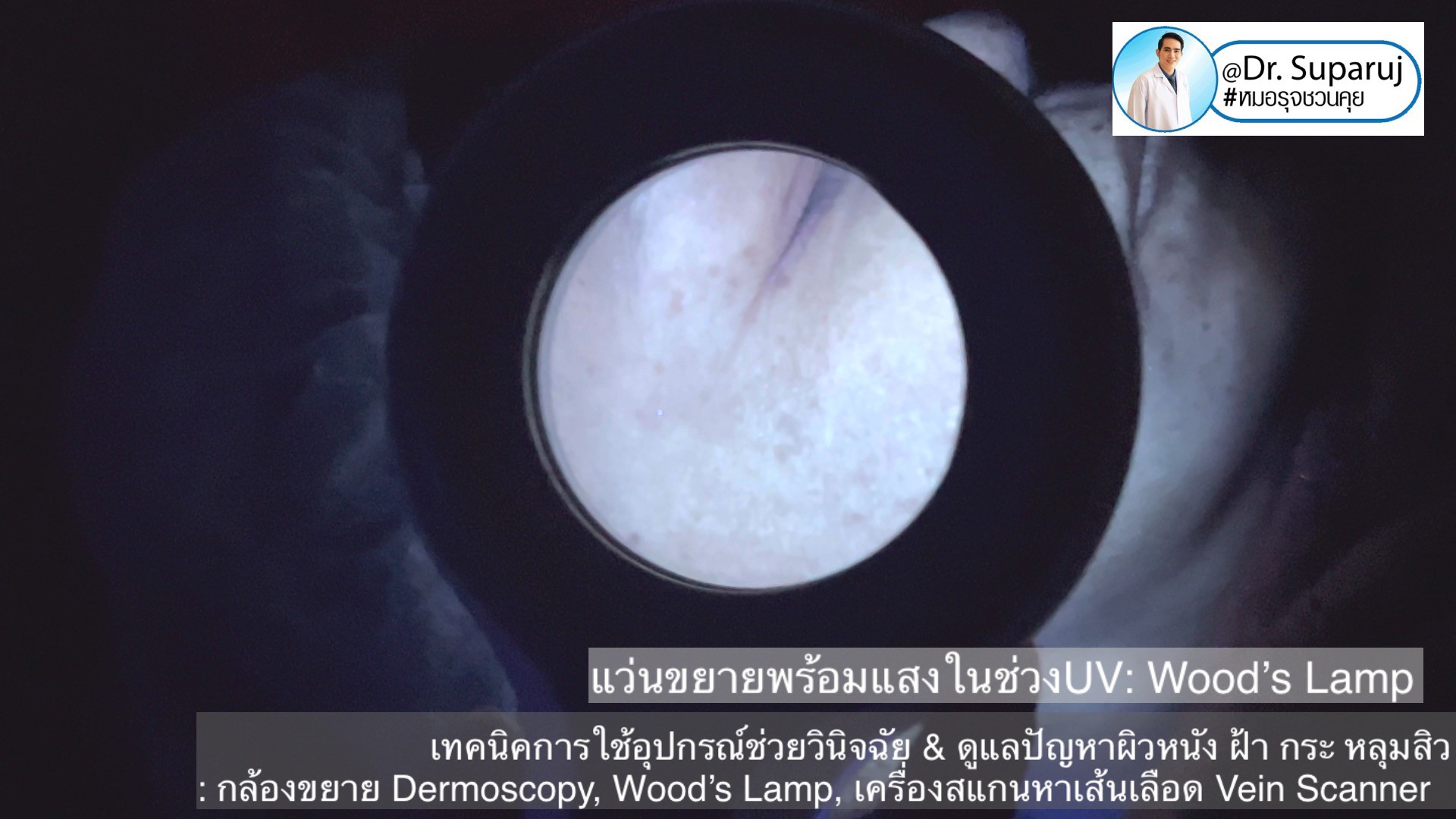 เทคนิคการใช้อุปกรณ์ช่วยวินิจฉัย & ดูแลปัญหาผิวหนัง ฝ้า กระ หลุมสิว: กล้องขยาย Dermoscopy, แว่นขยายพร้อมแสงในช่วงUV: Wood’s Lamp, เครื่องสแกนหาเส้นเลือด Vein Scanner เทคนิคการใช้อุปกรณ์ช่วยวินิจฉัย & ดูแลปัญหาผิวหนัง ฝ้า กระ หลุมสิว: กล้องขยาย Dermoscopy, แว่นขยายพร้อมแสงในช่วงUV: Wood’s Lamp, เครื่องสแกนหาเส้นเลือด Vein Scanner