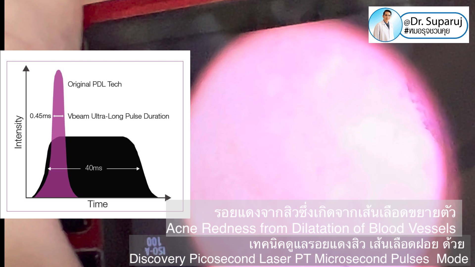 แนะนำเทคนิคดูแลรอยแดงสิว เส้นเลือดฝอย : เทคนิครักษารอยแดงสิว เส้นเลือดฝอย ด้วย Discovery Picosecond Laser PT Microsecond Pulses Mode 