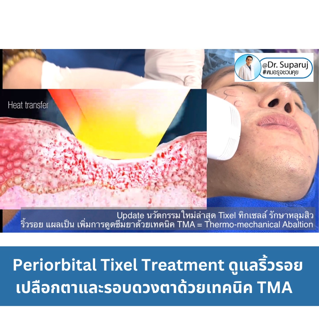 Update นวัตกรรมใหม่ล่าสุด Tixel ทิ๊กเซลล์ รักษาหลุมสิว ริ้วรอย แผลเป็น + Periorbital Tixel Treatment ดูแลริ้วรอยเปลือกตาและรอบดวงตาด้วยเทคนิค TMA = Thermo-mechanical Abaltion Update นวัตกรรมใหม่ล่าสุด Tixel ทิ๊กเซลล์ รักษาหลุมสิว ริ้วรอย แผลเป็น + Periorbital Tixel Treatment ดูแลริ้วรอยเปลือกตาและรอบดวงตาด้วยเทคนิค TMA = Thermo-mechanical Abaltion
