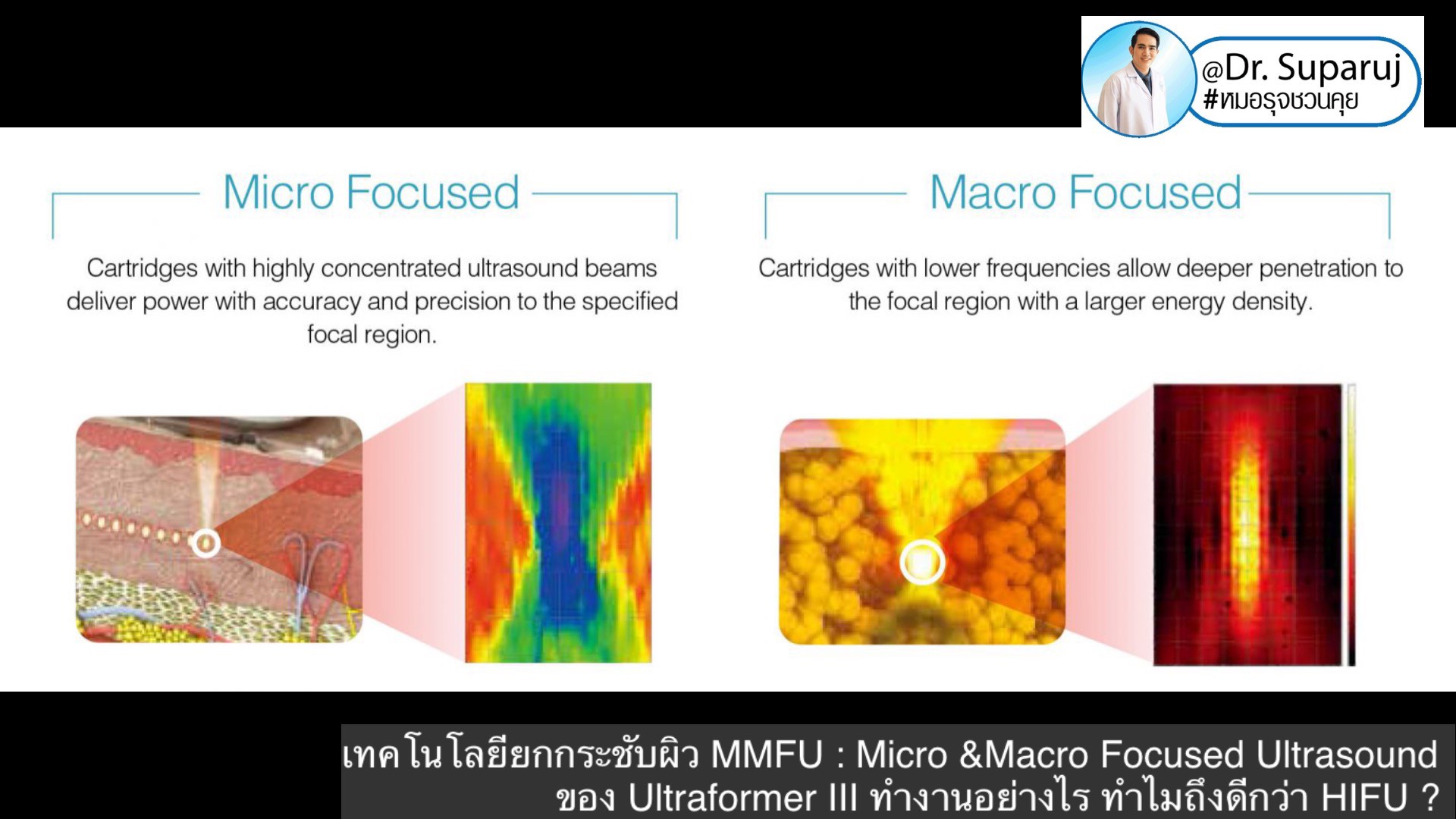 เทคโนโลยียกกระชับผิว MMFU : Micro &Macro Focused Ultrasound ของ Ultraformer III ทำงานอย่างไร ทำไมถึงดีกว่า HIFU ? เทคโนโลยียกกระชับผิว MMFU : Micro &Macro Focused Ultrasound ของ Ultraformer III ทำงานอย่างไร ทำไมถึงดีกว่า HIFU ?