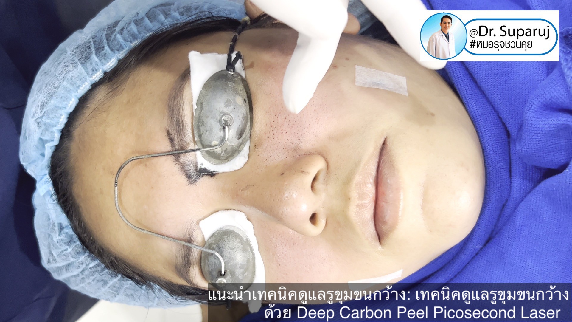 แนะนำเทคนิคดูแลรูขุมขนกว้าง: เทคนิคดูแลรูขุมขนกว้างด้วย Deep Carbon Peel Picosecond Laser (เทคนิคการใช้ Picosecond Laser พิโค่เลเซอร์ ร่วมกับผง carbon กระตุ้นการสร้างคอลลาเจนดูแลรูขุมขนกว้าง ) แนะนำเทคนิคดูแลรูขุมขนกว้าง: เทคนิคดูแลรูขุมขนกว้างด้วย Deep Carbon Peel Picosecond Laser (เทคนิคการใช้ Picosecond Laser พิโค่เลเซอร์ ร่วมกับผง carbon กระตุ้นการสร้างคอลลาเจนดูแลรูขุมขนกว้าง )