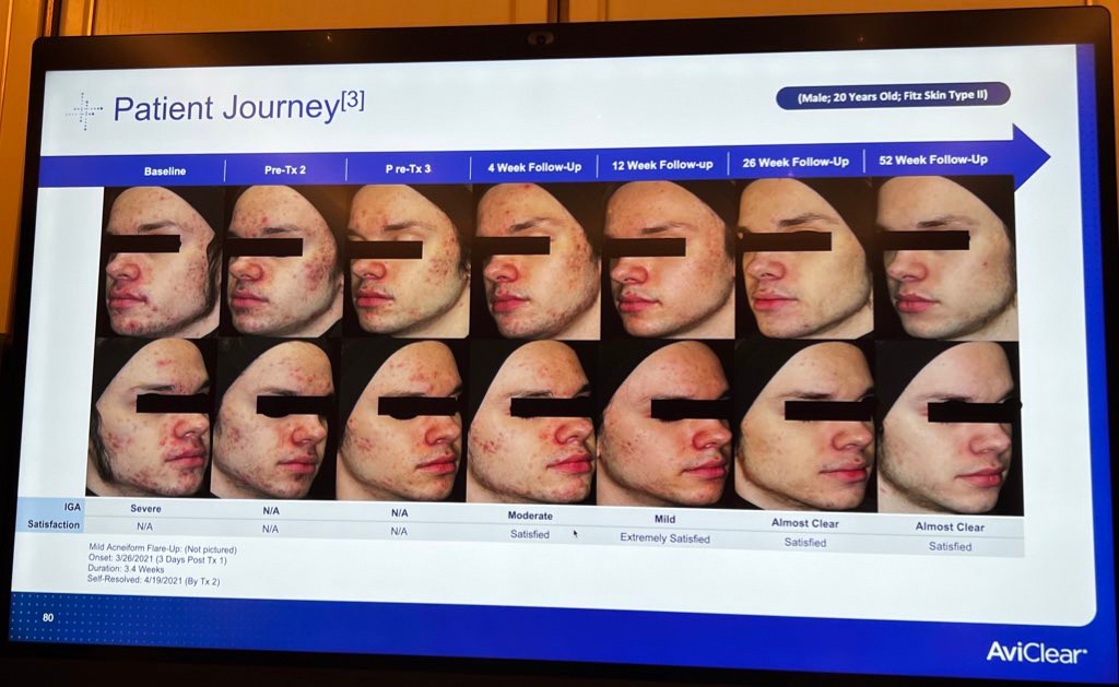 Update เครื่องเลเซอร์สำหรับรักษาสิวโดยเฉพาะ จับกับต่อมไขมันโดยตรง = AviClear 1726 nm Laser Update เครื่องเลเซอร์สำหรับรักษาสิวโดยเฉพาะ จับกับต่อมไขมันโดยตรง = AviClear 1726 nm Laser