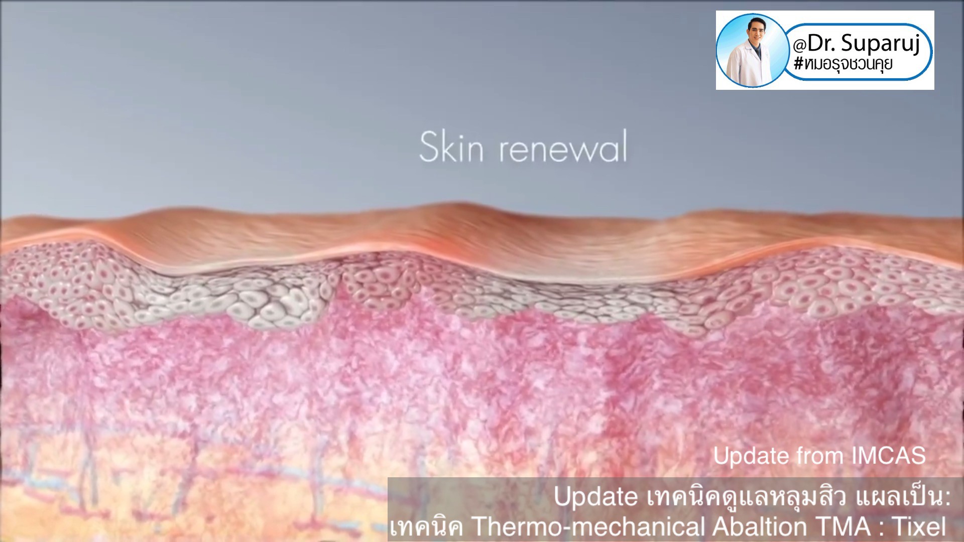 Update from IMCAS เทคนิครักษาหลุมสิว แผลเป็น ริ้วรอย: Tixel เทคนิค Thermo-mechanical Abaltion TMA Update from IMCAS เทคนิครักษาหลุมสิว แผลเป็น ริ้วรอย: Tixel เทคนิค Thermo-mechanical Abaltion TMA