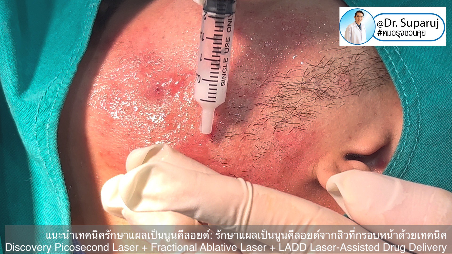 แนะนำเทคนิคดูแลแผลเป็นนูนคีลอยด์: รักษาแผลเป็นนูนคีลอยด์จากสิวที่กรอบหน้าด้วยเทคนิค Discovery Picosecond Laser + Fractional Ablative Laser + LADD Laser-Assisted Drug Delivery แนะนำเทคนิคดูแลแผลเป็นนูนคีลอยด์: รักษาแผลเป็นนูนคีลอยด์จากสิวที่กรอบหน้าด้วยเทคนิค Discovery Picosecond Laser + Fractional Ablative Laser + LADD Laser-Assisted Drug Delivery