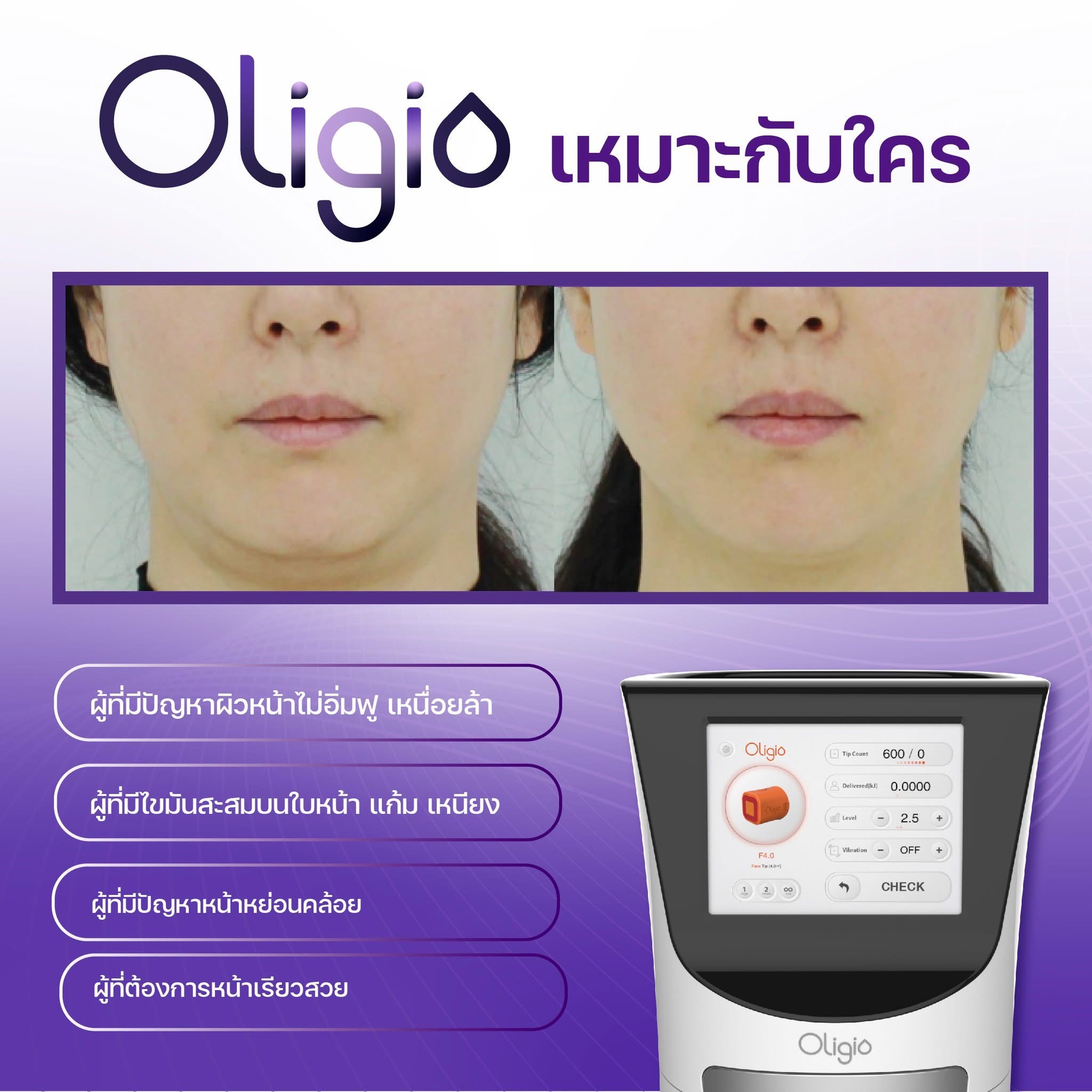 โปรแกรม Oligio ยกกระชับใหม่ ด้วยเทคโนโลยี Monopolar RF พลังงานคลื่นวิทยุ