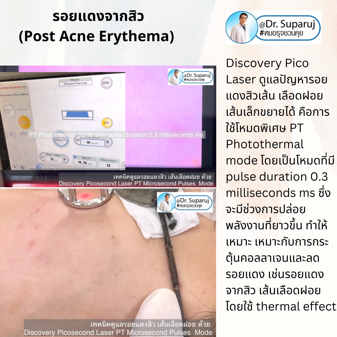 แนะนำเทคนิคดูแลรอยแดงสิว เส้นเลือดฝอย : เทคนิครักษารอยแดงสิว เส้นเลือดฝอย ด้วย Discovery Picosecond Laser PT Microsecond Pulses Mode แนะนำเทคนิคดูแลรอยแดงสิว เส้นเลือดฝอย : เทคนิครักษารอยแดงสิว เส้นเลือดฝอย ด้วย Discovery Picosecond Laser PT Microsecond Pulses Mode