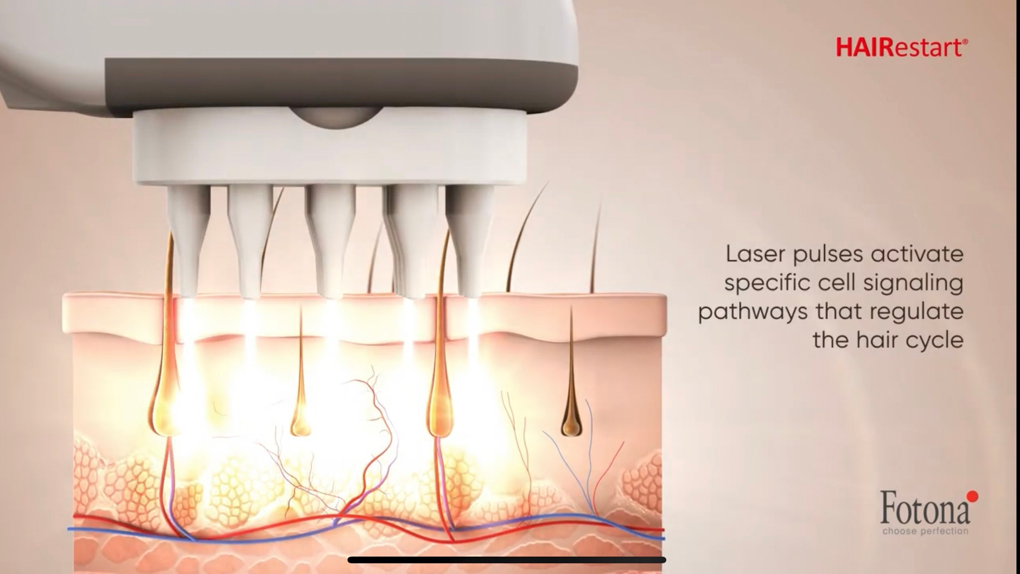 Update เทคนิค (เสริม)ดูแลผมร่วงผมบางจากพันธุกรรม AGA Update เทคนิค (เสริม)ดูแลผมร่วงผมบางจากพันธุกรรม AGA