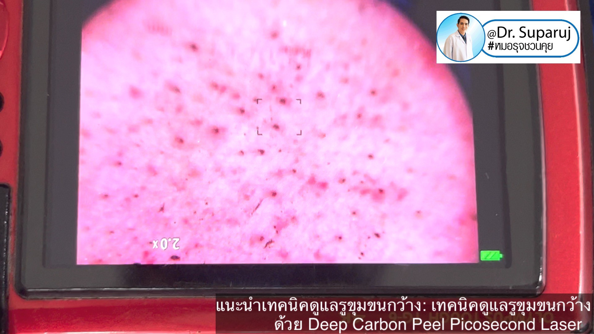 แนะนำเทคนิคดูแลรูขุมขนกว้าง: เทคนิคดูแลรูขุมขนกว้างด้วย Deep Carbon Peel Picosecond Laser (เทคนิคการใช้ Picosecond Laser พิโค่เลเซอร์ ร่วมกับผง carbon กระตุ้นการสร้างคอลลาเจนดูแลรูขุมขนกว้าง )