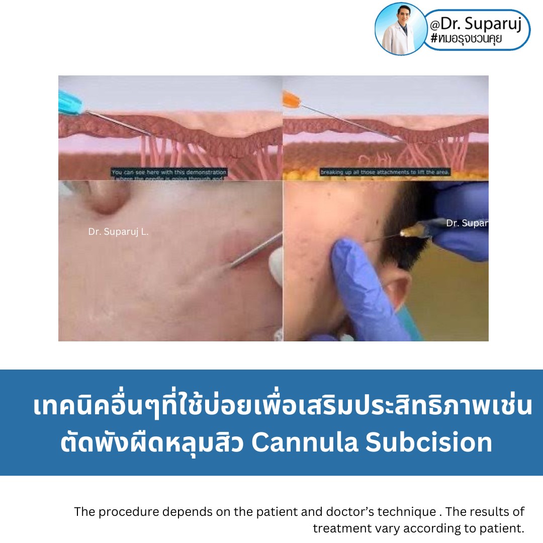 เทคนิคโปรแกรมรักษาหลุมสิว ที่หมอใช้บ่อยครับ เทคนิคโปรแกรมรักษาหลุมสิว ที่หมอใช้บ่อยครับ