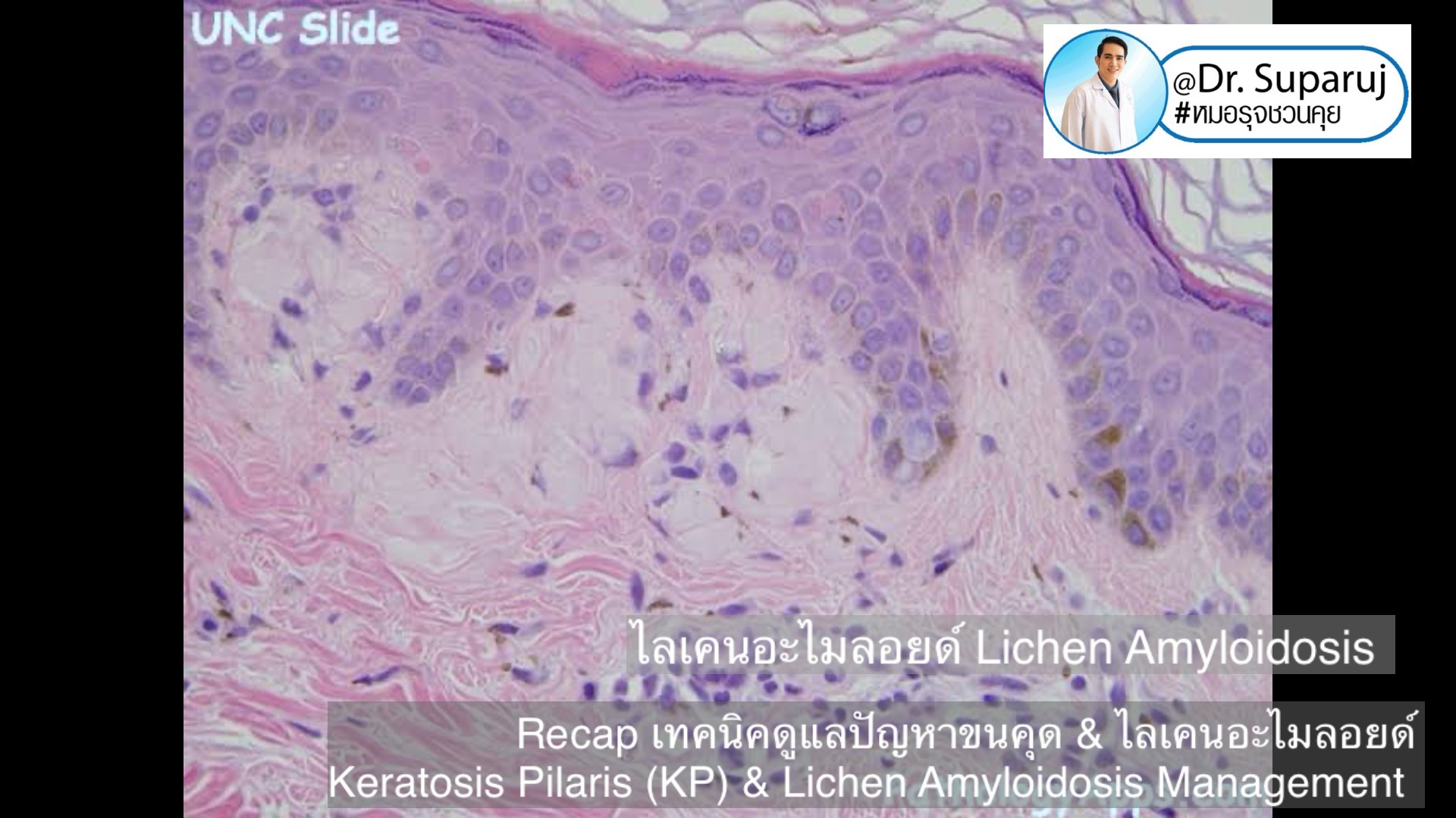 Recap เทคนิคดูแลปัญหาขนคุด & ไลเคนอะไมลอยด์ Keratosis Pilaris (KP) & Lichen Amyloidosis Management