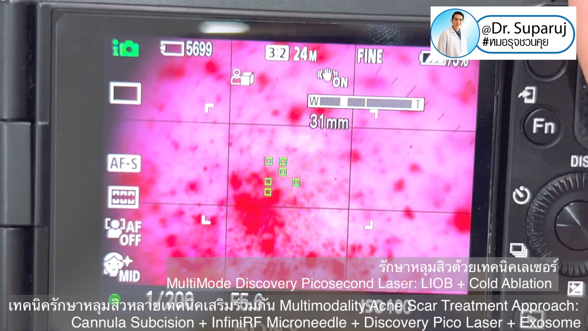 เทคนิครักษาหลุมสิวด้วยหลายเทคนิคเสริมร่วมกัน Multimodality Acne Scar Treatment Approach: Cannula Subcision + InfiniRF Microneedle + Discovery Pico Laser + Exosome เทคนิครักษาหลุมสิวด้วยหลายเทคนิคเสริมร่วมกัน Multimodality Acne Scar Treatment Approach: Cannula Subcision + InfiniRF Microneedle + Discovery Pico Laser + Exosome