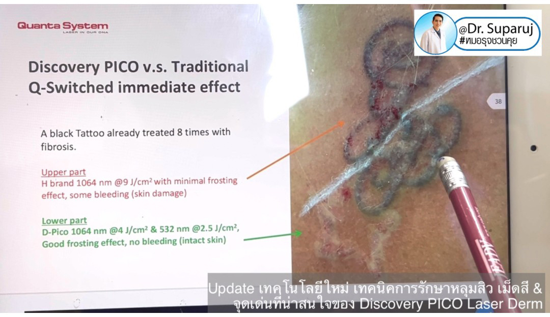 Update เทคโนโลยีใหม่ เทคนิคการรักษาหลุมสิว เม็ดสี & จุดเด่นที่น่าสนใจของ Discovery PICO Laser Derm Update เทคโนโลยีใหม่ เทคนิคการรักษาหลุมสิว เม็ดสี & จุดเด่นที่น่าสนใจของ Discovery PICO Laser Derm