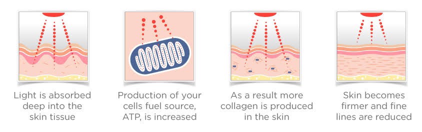 โปรแกรม PORA COOL + Skin Radiant Treatment โพล่าร์คูล + สกินเรเดียน ทรีทเมนท์ หน้ากระจ่างใส ลดการอักเสบของผิว ลดสิว