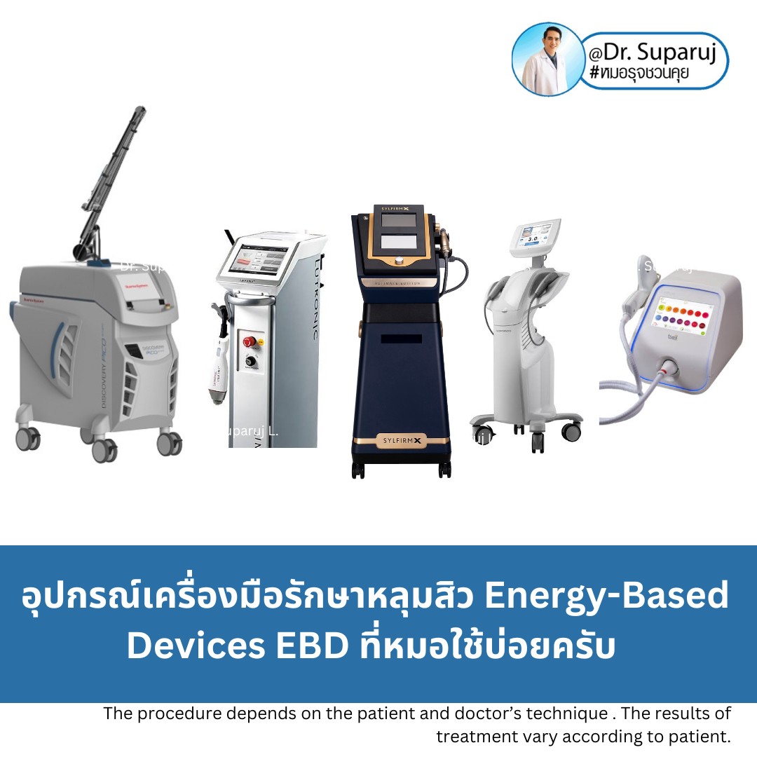 Update Energy-based Devices EBD อุปกรณ์เครื่องมือ ที่มีให้การดูแลรักษา ปัญหาผิว หลุมสิว ผมร่วงผมบาง แผลเป็น ขนคุดครับ (Update November 2023) Update Energy-based Devices EBD อุปกรณ์เครื่องมือ ที่มีให้การดูแลรักษา ปัญหาผิว หลุมสิว ผมร่วงผมบาง แผลเป็น ขนคุดครับ (Update November 2023)
