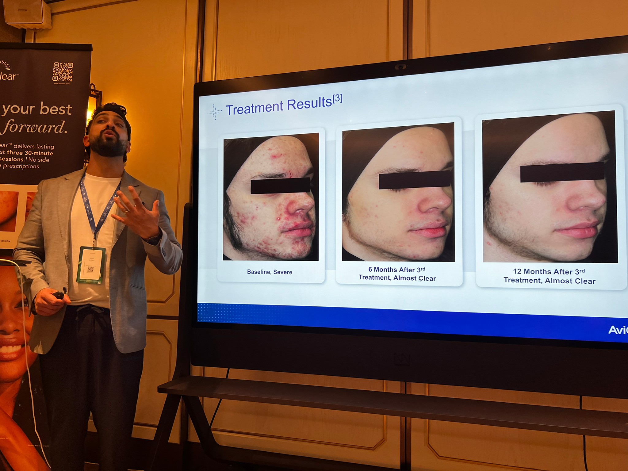 Update เครื่องเลเซอร์สำหรับรักษาสิวโดยเฉพาะ จับกับต่อมไขมันโดยตรง = AviClear 1726 nm Laser Update เครื่องเลเซอร์สำหรับรักษาสิวโดยเฉพาะ จับกับต่อมไขมันโดยตรง = AviClear 1726 nm Laser