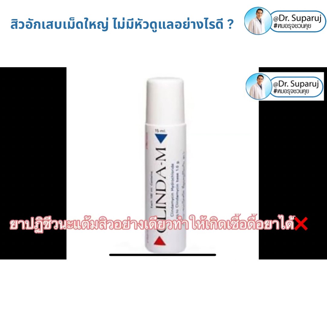 มีสิวอักเสบเม็ดใหญ่ ไม่มีหัว ขึ้น ดูแลอย่างไรดี ? มีสิวอักเสบเม็ดใหญ่ ไม่มีหัว ขึ้น ดูแลอย่างไรดี ?