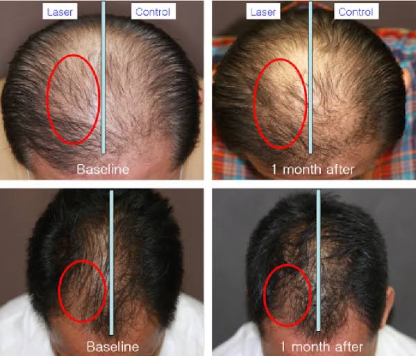 Update เทคนิค (เสริม)ดูแลผมร่วงผมบางจากพันธุกรรม AGA Update เทคนิค (เสริม)ดูแลผมร่วงผมบางจากพันธุกรรม AGA