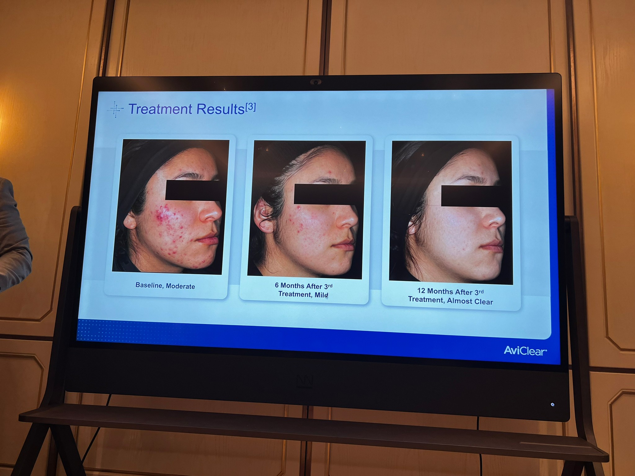 Update เครื่องเลเซอร์สำหรับรักษาสิวโดยเฉพาะ จับกับต่อมไขมันโดยตรง = AviClear 1726 nm Laser Update เครื่องเลเซอร์สำหรับรักษาสิวโดยเฉพาะ จับกับต่อมไขมันโดยตรง = AviClear 1726 nm Laser