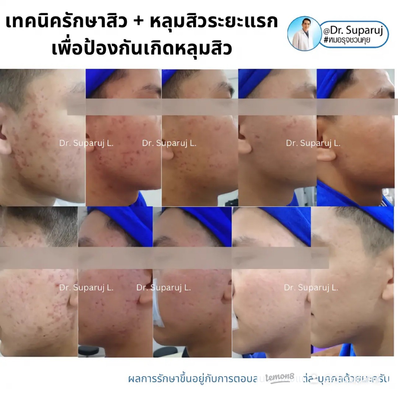 แนะนำเทคนิคดูแลรูขุมขนกว้าง: เทคนิคดูแลรูขุมขนกว้างด้วย Deep Carbon Peel Picosecond Laser (เทคนิคการใช้ Picosecond Laser พิโค่เลเซอร์ ร่วมกับผง carbon กระตุ้นการสร้างคอลลาเจนดูแลรูขุมขนกว้าง ) แนะนำเทคนิคดูแลรูขุมขนกว้าง: เทคนิคดูแลรูขุมขนกว้างด้วย Deep Carbon Peel Picosecond Laser (เทคนิคการใช้ Picosecond Laser พิโค่เลเซอร์ ร่วมกับผง carbon กระตุ้นการสร้างคอลลาเจนดูแลรูขุมขนกว้าง )
