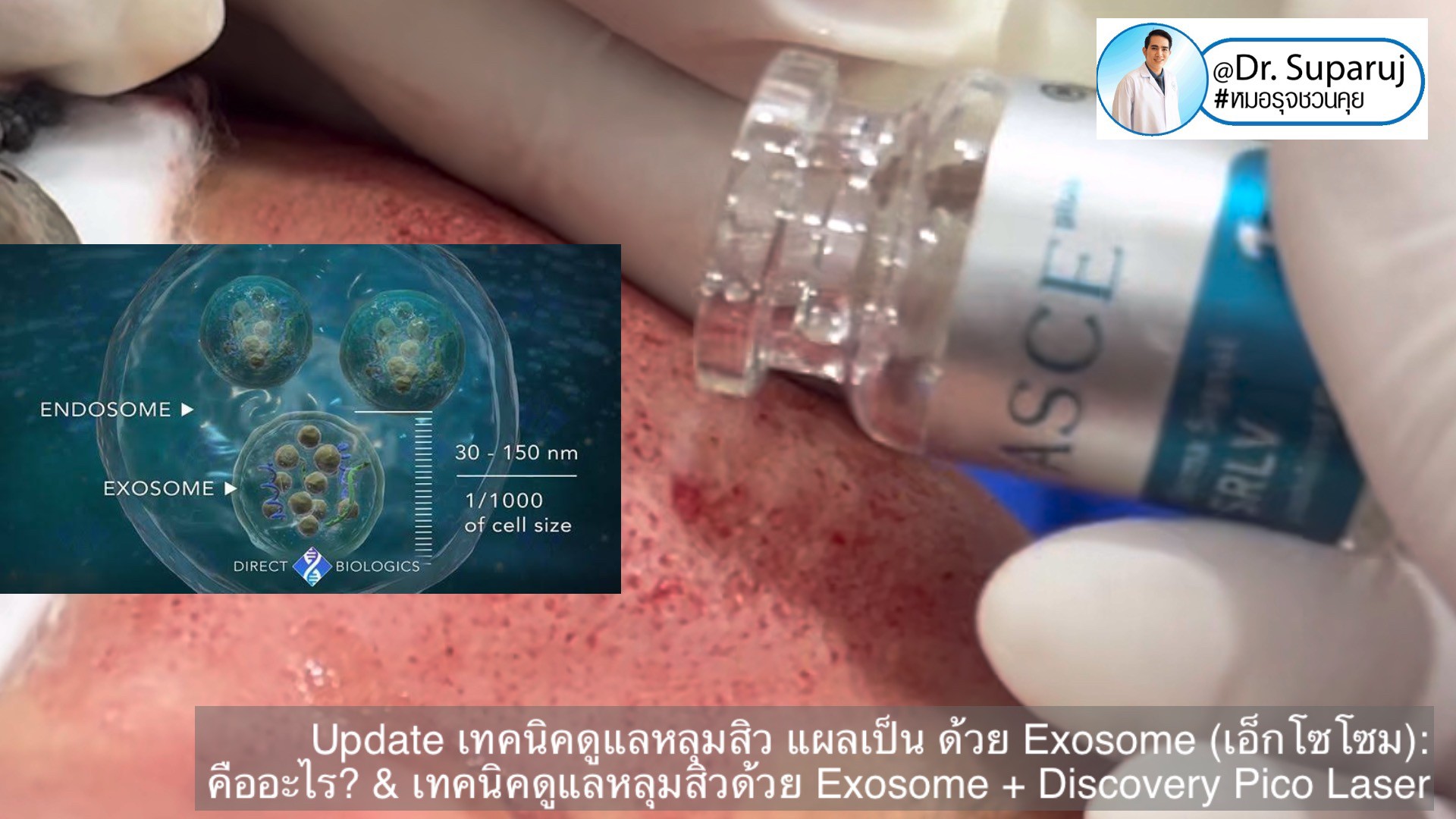 แนะนำเทคนิคในการดูแลหลุมสิว: Exosome ใน การรักษาหลุมสิว (Exosome & acne scar treatment)