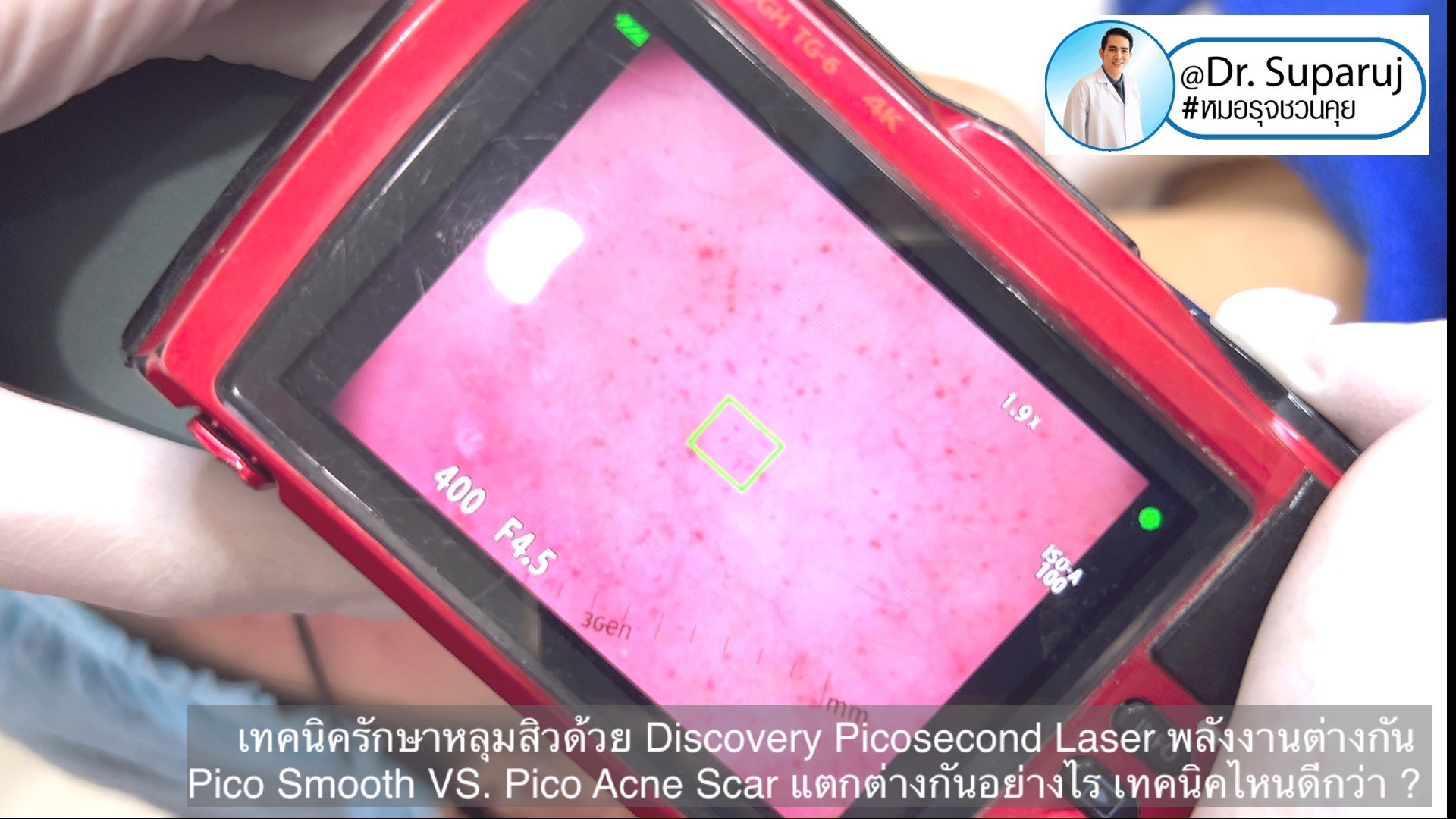 Q:Picosecond Laser หลุมสิวต้องยิงให้เลือดสาดไหม? Q:Picosecond Laser หลุมสิวต้องยิงให้เลือดสาดไหม?