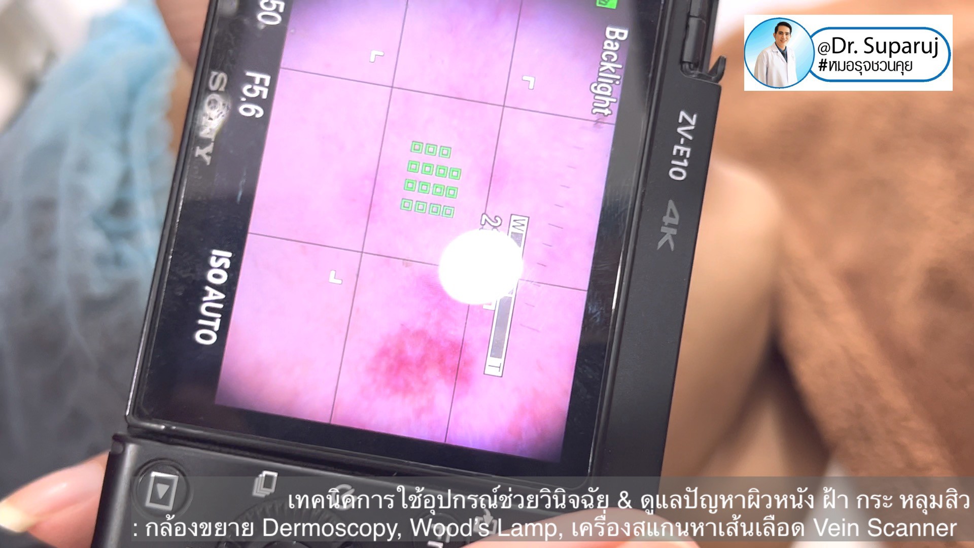 เทคนิคการใช้อุปกรณ์ช่วยวินิจฉัย & ดูแลปัญหาผิวหนัง ฝ้า กระ หลุมสิว: กล้องขยาย Dermoscopy, แว่นขยายพร้อมแสงในช่วงUV: Wood’s Lamp, เครื่องสแกนหาเส้นเลือด Vein Scanner เทคนิคการใช้อุปกรณ์ช่วยวินิจฉัย & ดูแลปัญหาผิวหนัง ฝ้า กระ หลุมสิว: กล้องขยาย Dermoscopy, แว่นขยายพร้อมแสงในช่วงUV: Wood’s Lamp, เครื่องสแกนหาเส้นเลือด Vein Scanner