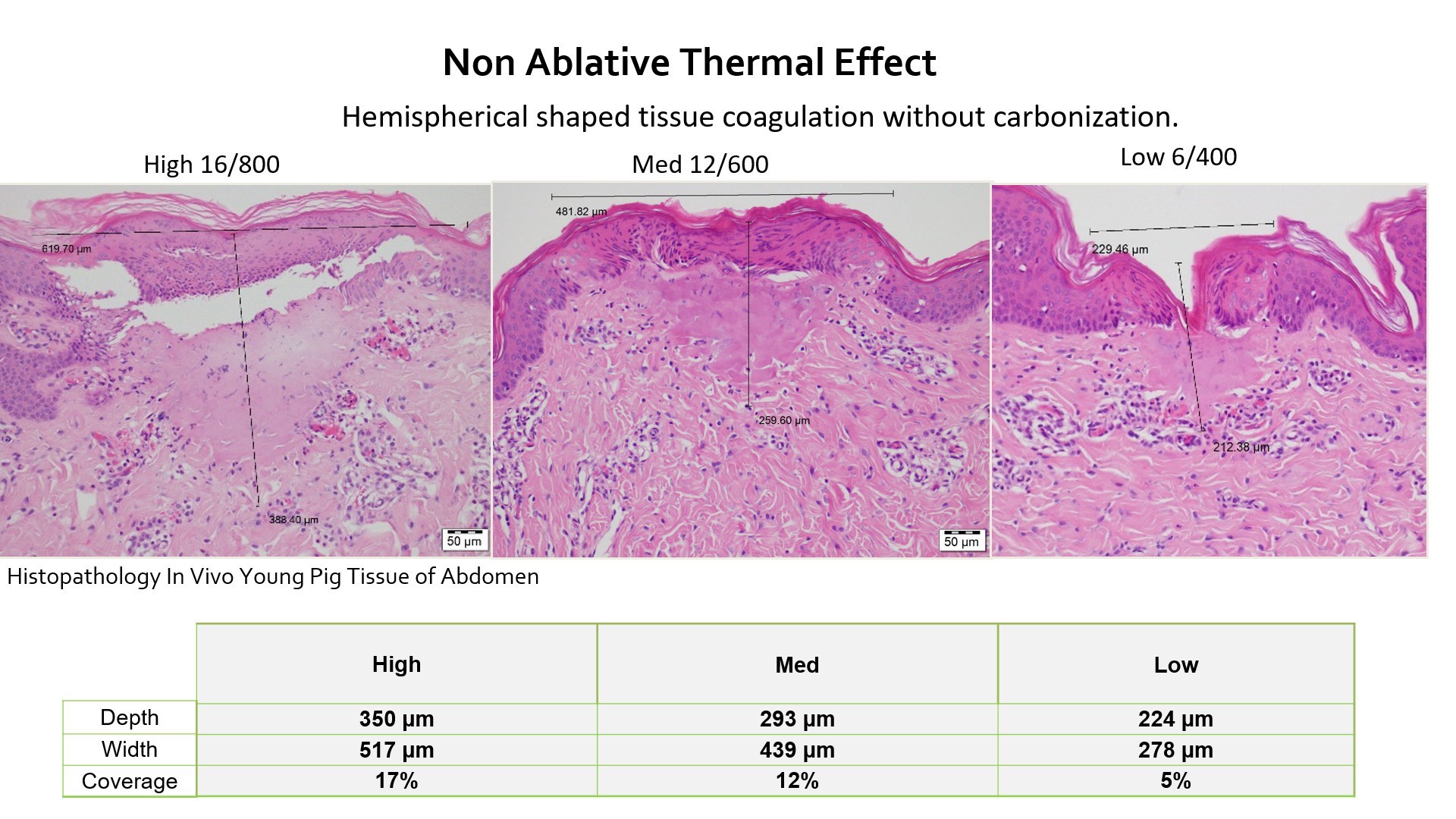 Update เทคนิครักษาหลุมสิว: Tixel ทิ๊กเซลล์ รักษาหลุมสิว ริ้วรอย แผลเป็น เพิ่มการดูดซึมยาด้วยเทคนิค TMA = Thermo-mechanical Abaltion Update เทคนิครักษาหลุมสิว: Tixel ทิ๊กเซลล์ รักษาหลุมสิว ริ้วรอย แผลเป็น เพิ่มการดูดซึมยาด้วยเทคนิค TMA = Thermo-mechanical Abaltion