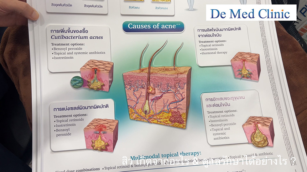 สิว เกิดจากอะไร & ดูแลรักษาได้อย่างไร ?