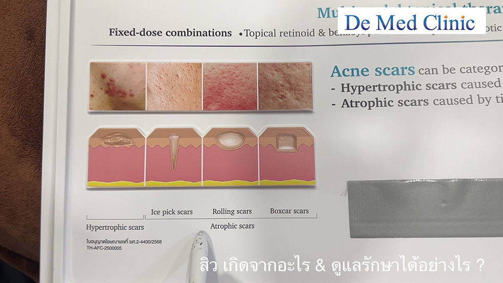 สิว เกิดจากอะไร & ดูแลรักษาได้อย่างไร ? สิว เกิดจากอะไร & ดูแลรักษาได้อย่างไร ?