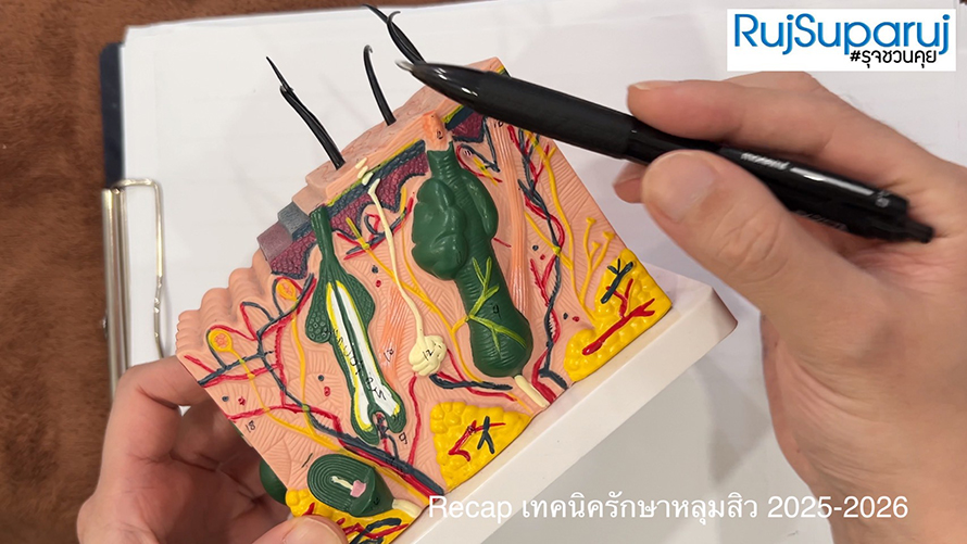 Recap เทคนิครักษาหลุมสิว 2025-2026 Recap เทคนิครักษาหลุมสิว 2025-2026