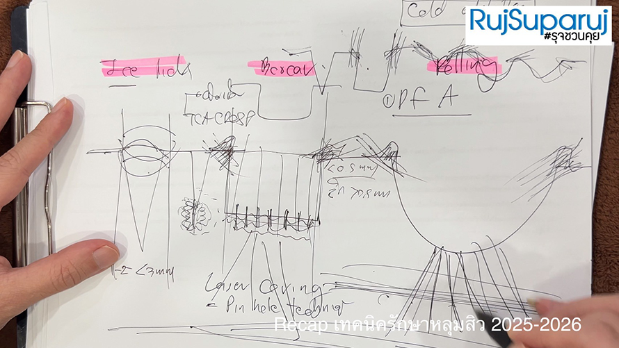 Recap เทคนิครักษาหลุมสิว 2025-2026 Recap เทคนิครักษาหลุมสิว 2025-2026