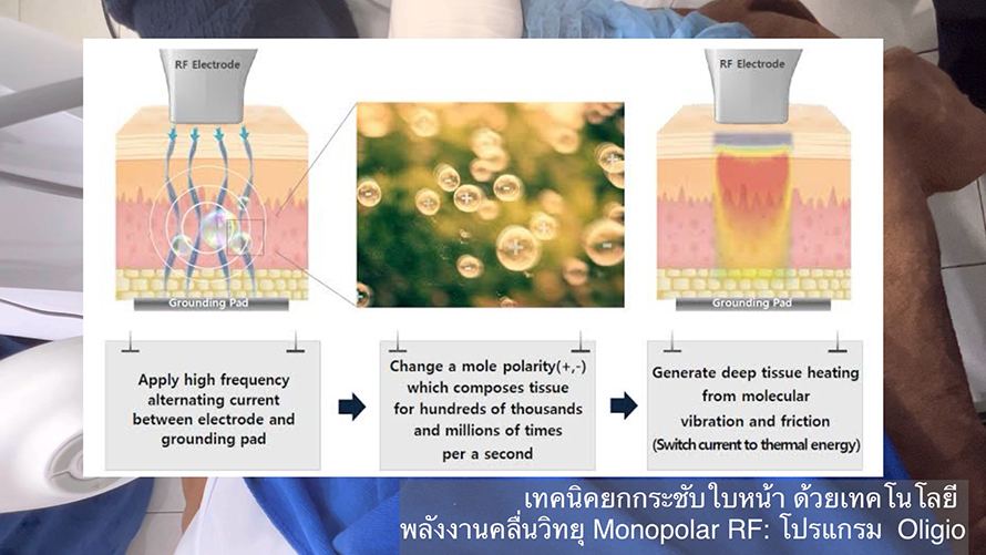 โปรแกรม Oligio แนะนำเทคโนโลยีการยกกระชับใบหน้าด้วย Monopolar RF (Radio Frequency) โดยใช้โปรแกรม Oligio โดยมีประเด็นสำคัญสรุปได้ดังนี้ครับ: