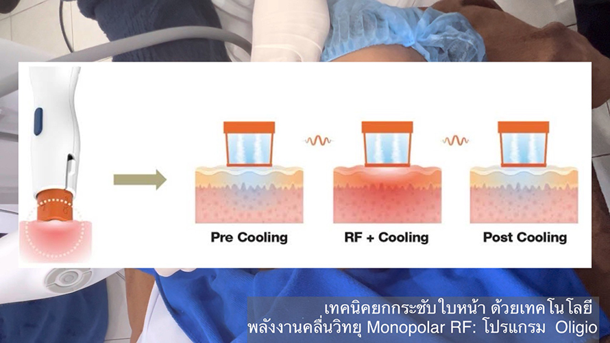 โปรแกรม Oligio แนะนำเทคโนโลยีการยกกระชับใบหน้าด้วย Monopolar RF (Radio Frequency) โดยใช้โปรแกรม Oligio โดยมีประเด็นสำคัญสรุปได้ดังนี้ครับ: โปรแกรม Oligio แนะนำเทคโนโลยีการยกกระชับใบหน้าด้วย Monopolar RF (Radio Frequency) โดยใช้โปรแกรม Oligio โดยมีประเด็นสำคัญสรุปได้ดังนี้ครับ: