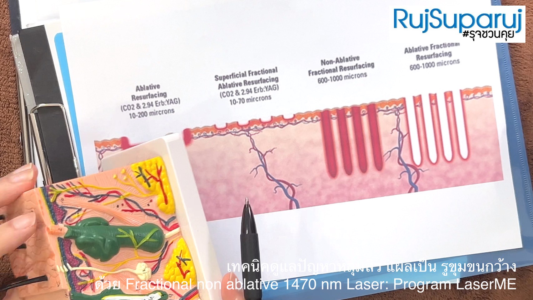เทคนิคดูแลปัญหาหลุมสิว ด้วย Fractional non ablative 1470 nm Laser: Program LaserME เทคนิคดูแลปัญหาหลุมสิว ด้วย Fractional non ablative 1470 nm Laser: Program LaserME