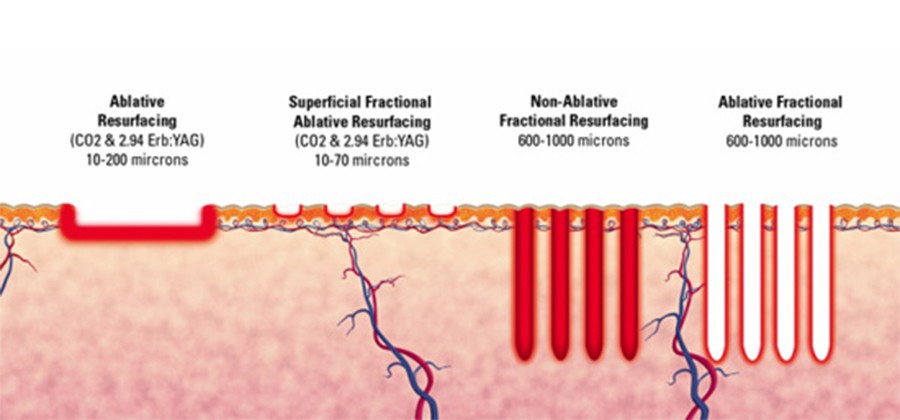 กลไกการทำงานของ Program LaserMe กลไกการทำงานของ Program LaserMe
