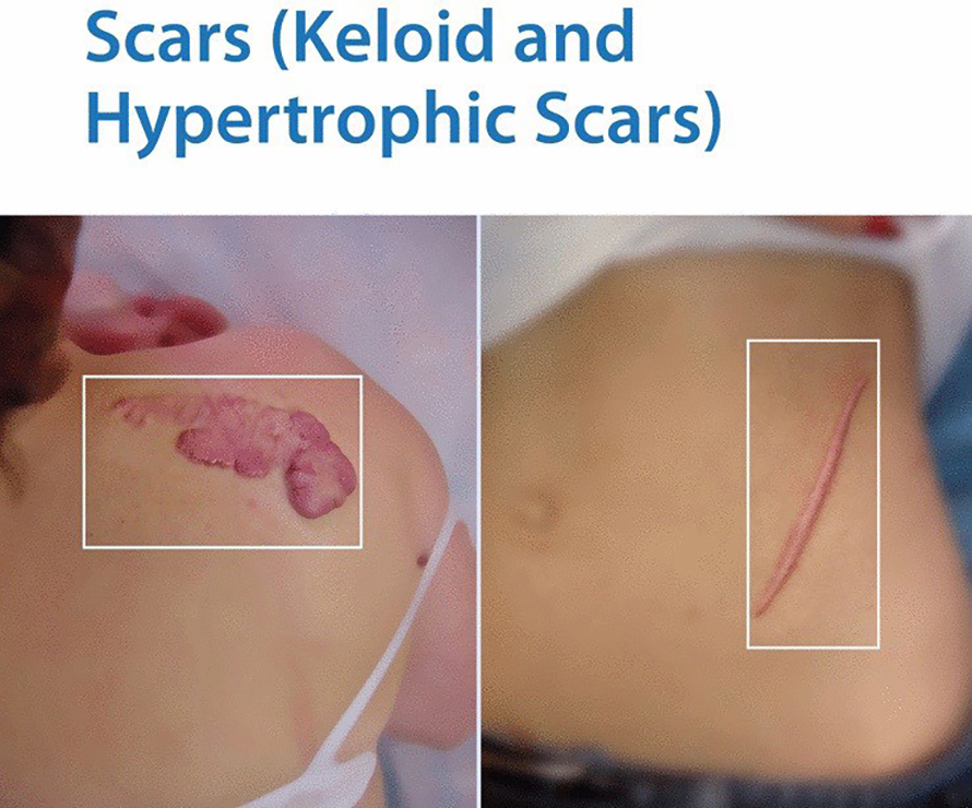 รอยแดงในแผลเป็นนูนลอยด์ Keloid Scar Redness เกิดจากอะไร & ดูแลได้อย่างไร ? รอยแดงในแผลเป็นนูนลอยด์ Keloid Scar Redness เกิดจากอะไร & ดูแลได้อย่างไร ?