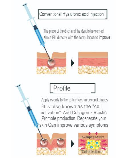 เทคนิครักษาหลุมสิว ด้วยการตัดพังผืดหลุมสิวเทคนิค Program Profhilo Bio-Remodeling Fanning Subcision Techniques for Acne Scar Treatment