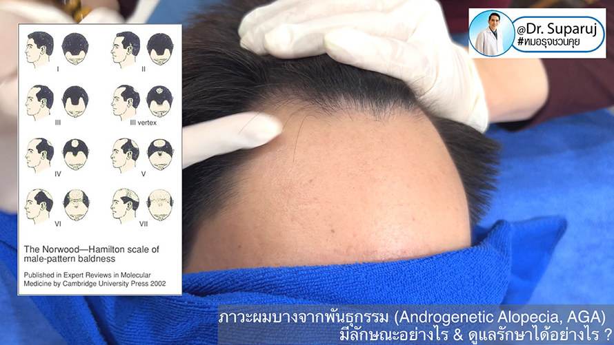 แนวทางการวินิจฉัยและรักษาภาวะผมบางจากพันธุกรรม (Androgenetic Alopecia)