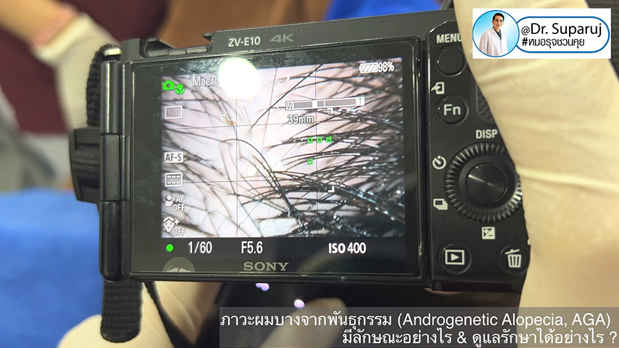 แนวทางการวินิจฉัยและรักษาภาวะผมบางจากพันธุกรรม (Androgenetic Alopecia) แนวทางการวินิจฉัยและรักษาภาวะผมบางจากพันธุกรรม (Androgenetic Alopecia)