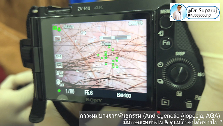 แนวทางการวินิจฉัยและรักษาภาวะผมบางจากพันธุกรรม (Androgenetic Alopecia)
